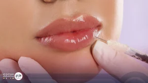 تزریق فیلر لب