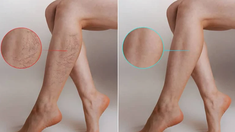 درمان واریس پا با روشهای پزشکی و خانگی