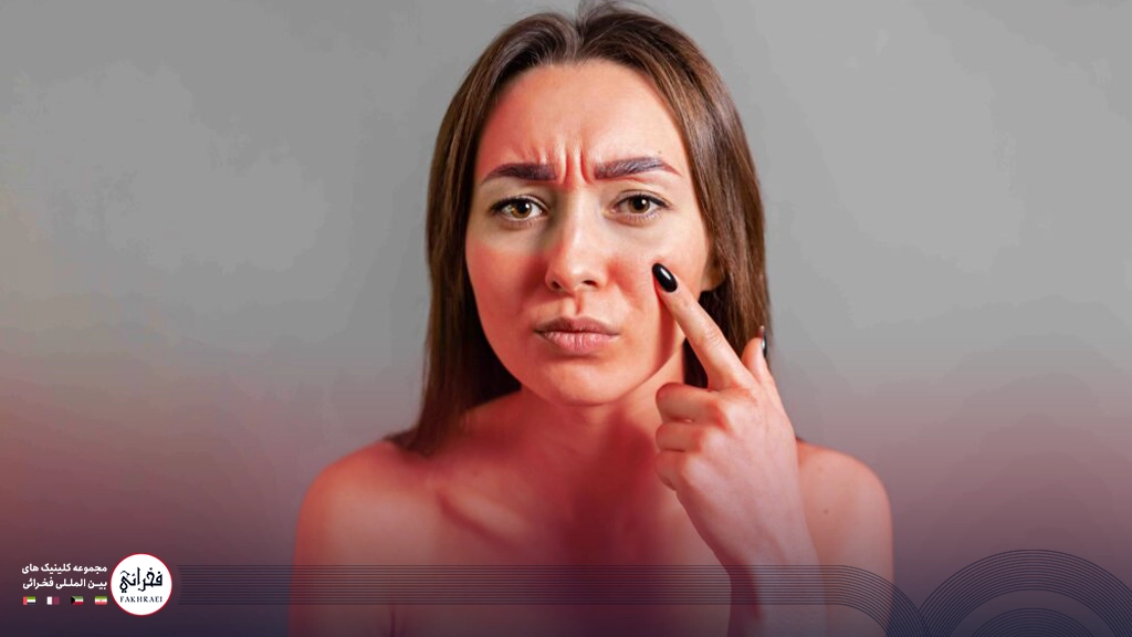 درمان آفتاب سوختگی صورت