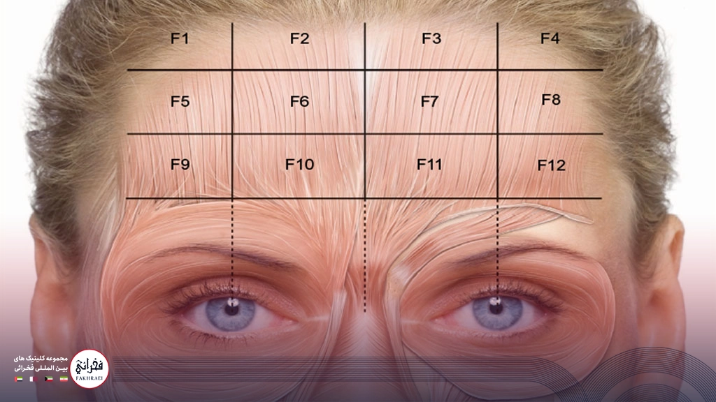 نقاط تزریق بوتاکس برای میگرن