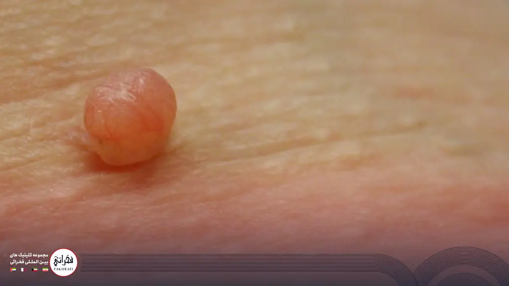 1 عدد زگیل تناسلی مردی