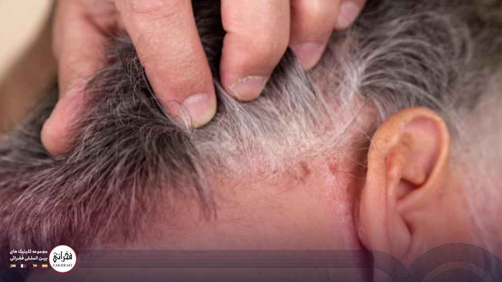 مردی درمان قارچ پوست سر