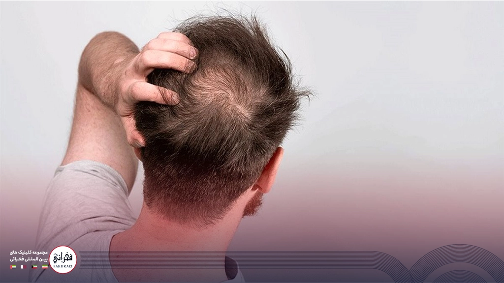 مردی در حال بررسی پوست سر خود