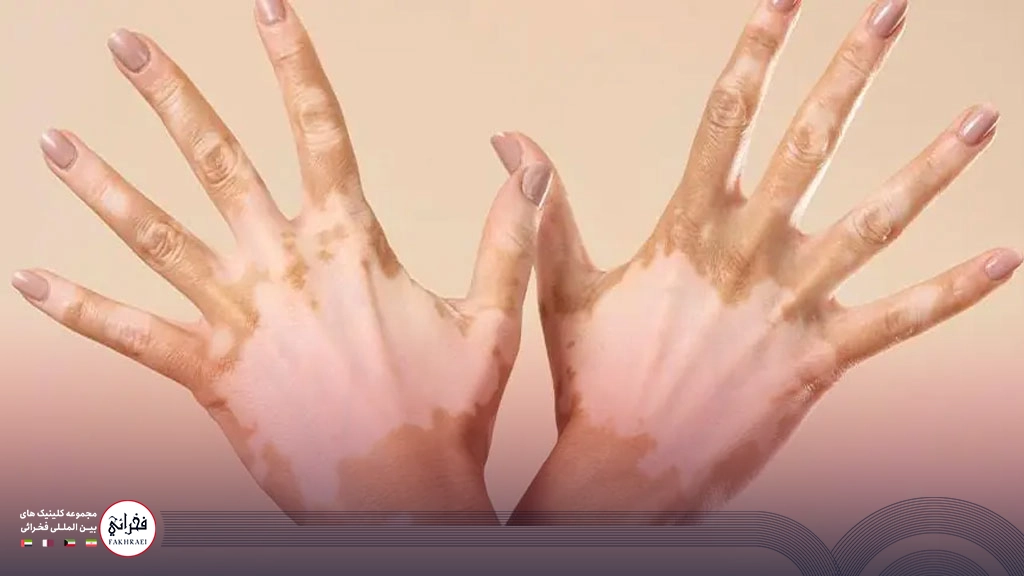 درمان پیسی دست