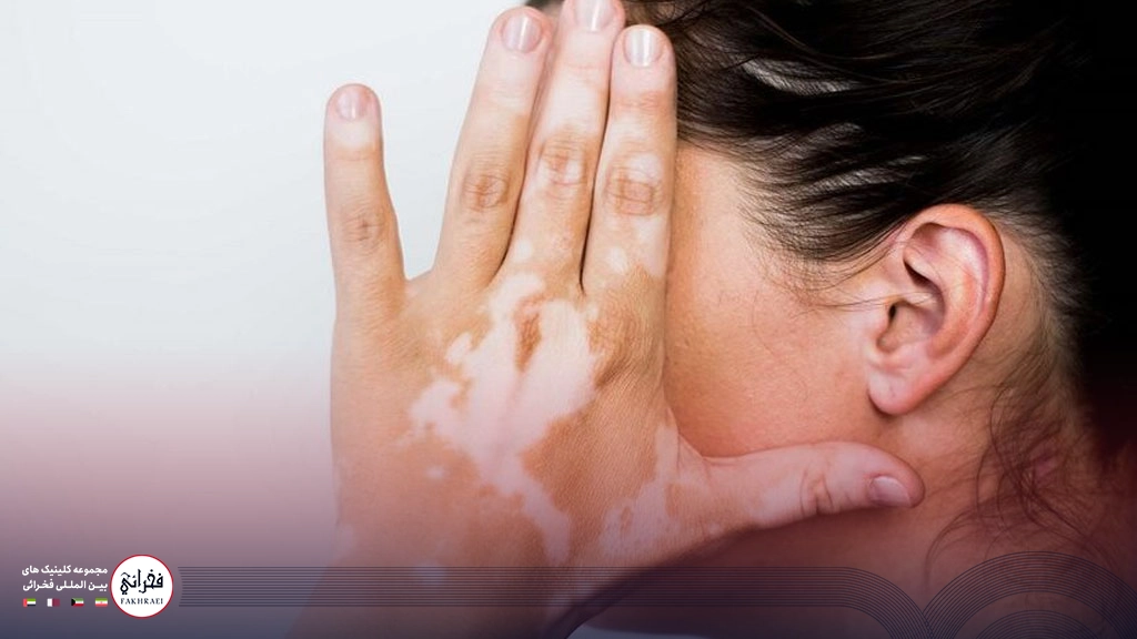 درمان پیسی روی دست خانمی