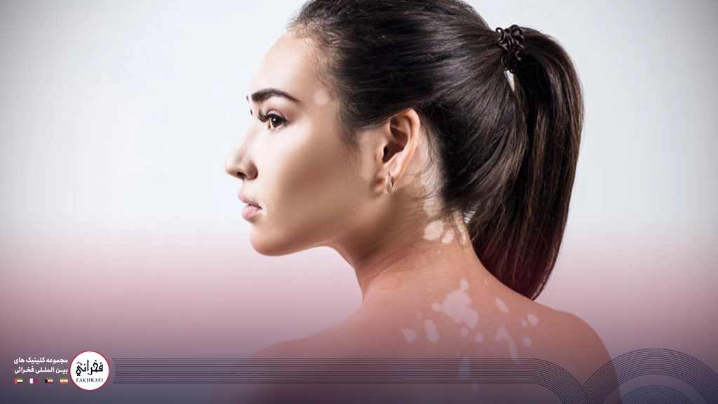 خانمی دچار بیماری پیسی در پشت بدن خود