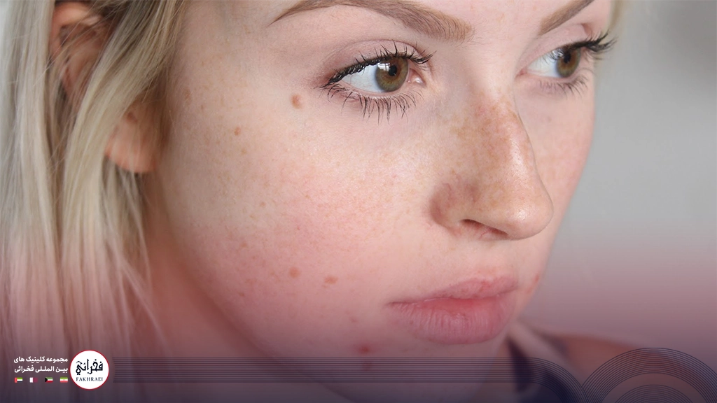 دختری با پوست چرب و جوش دار