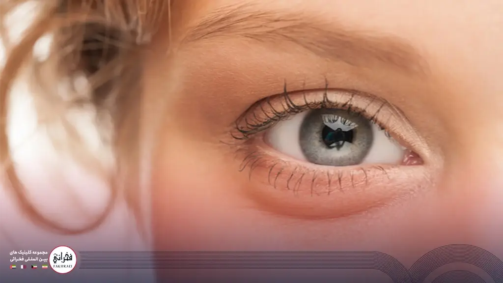 علت به وجود آمدن پف زیر چشم