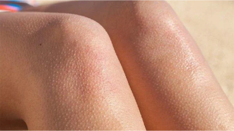 بررسی انواع روشهای درمان پوست مرغی + دلایل ایجاد