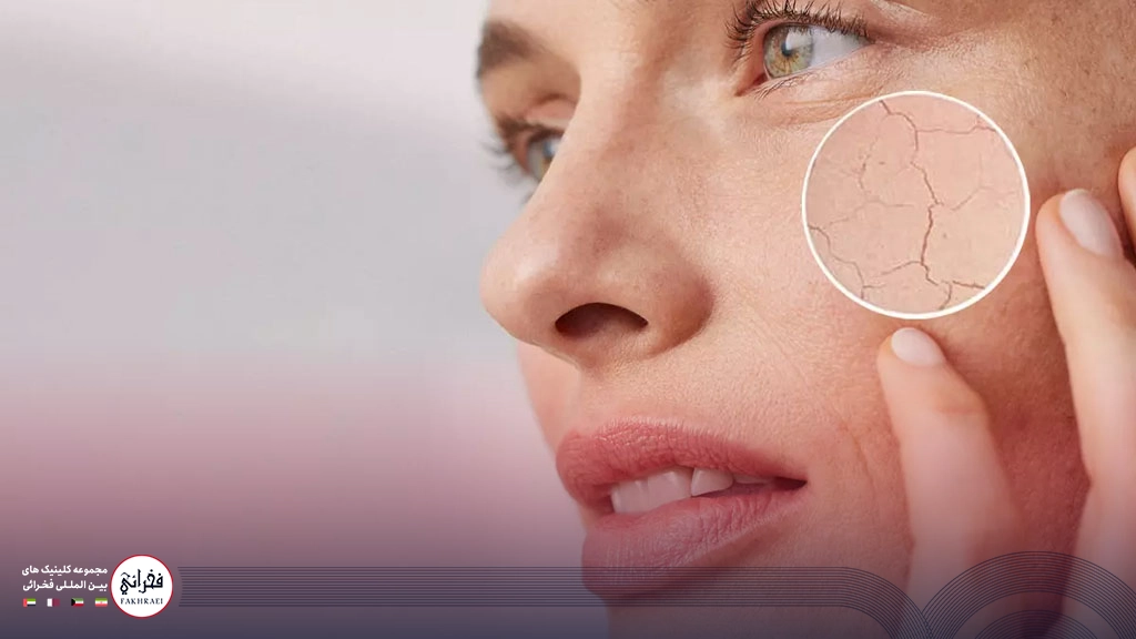 درمان خشکی پوست صورت