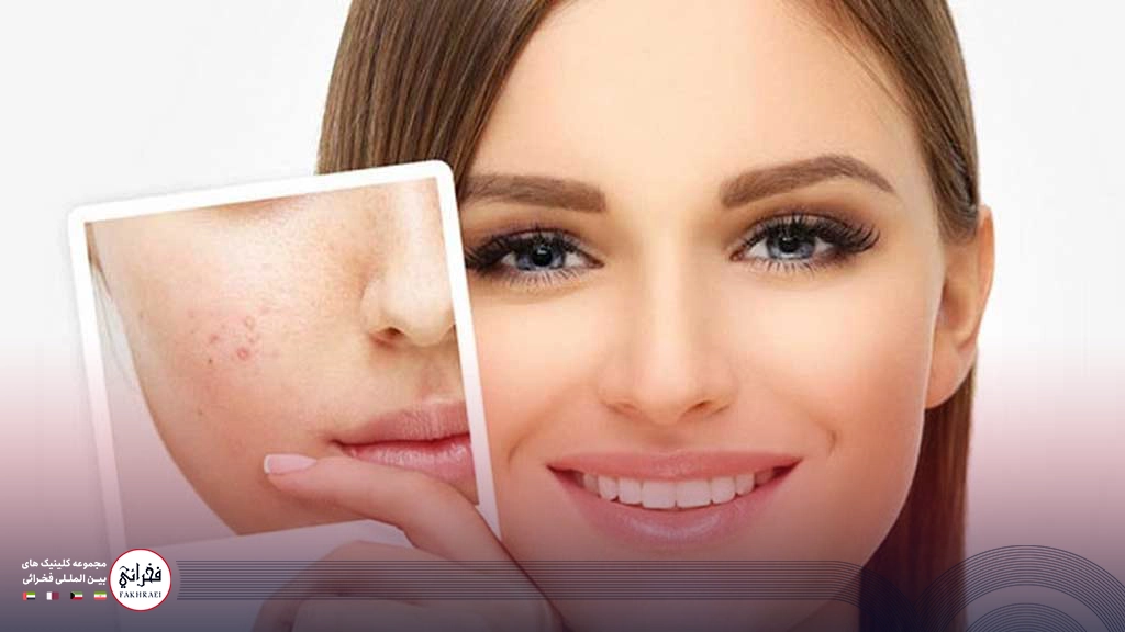 رفع چین و چروک صورت