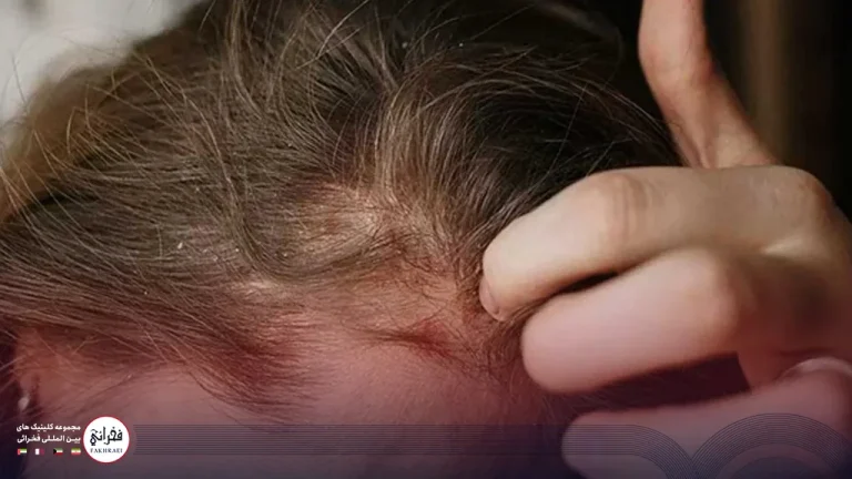 درمان پسوریازیس سر در کلینیک پوست و مو فخرائی