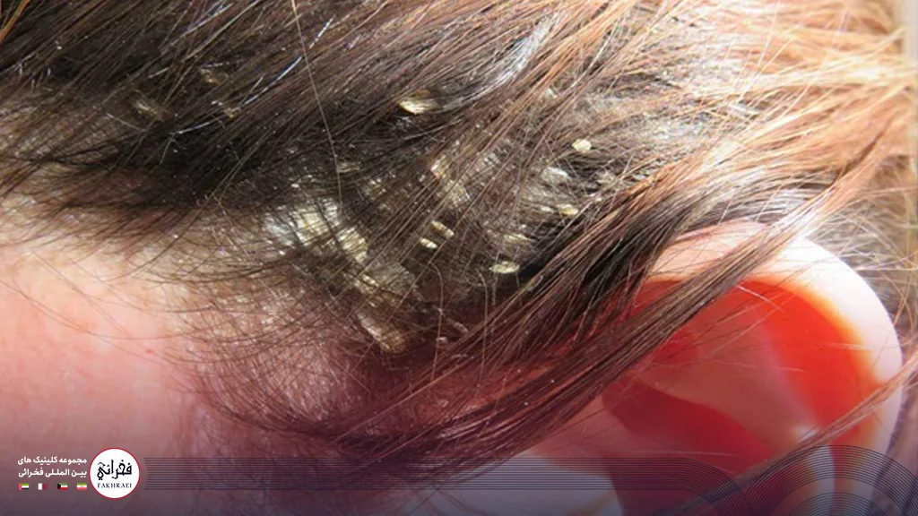 خانمی دچار بیماری شدید پسوریازیس پوست سر