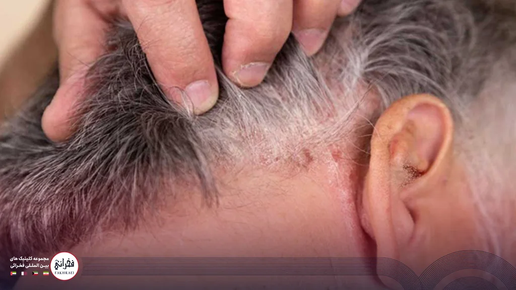 مردی با موهای سفید دچار بیماری پسوریازیس سر
