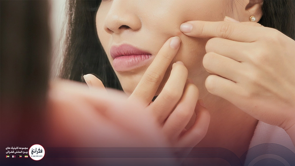 دختری در حال درآوردن جوشهای زیر پوستی صورت