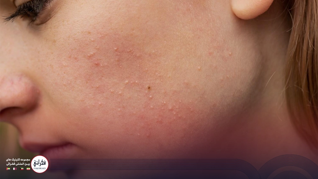 دختری با جوشهای زیر پوستی صورت