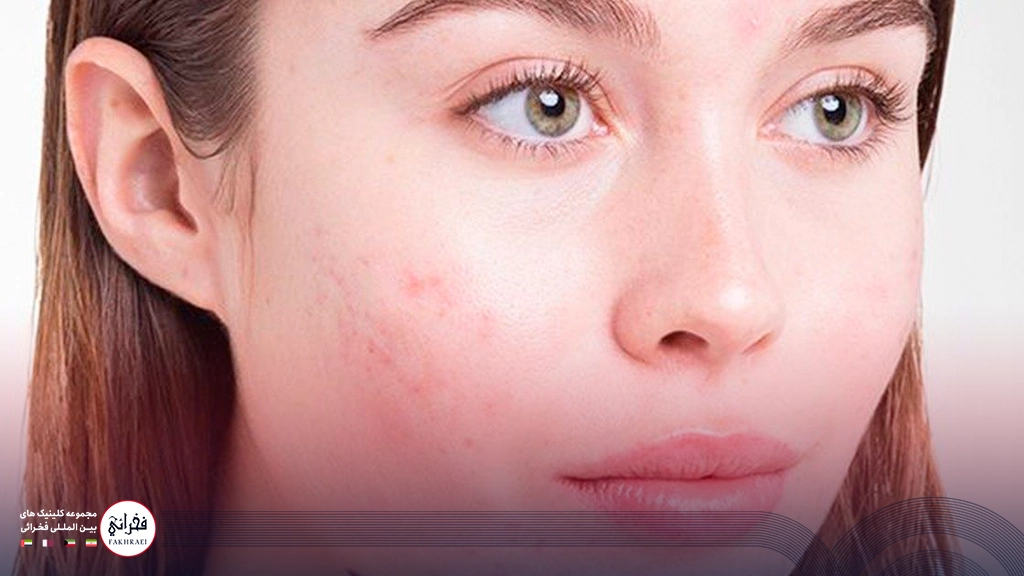 جوشهای زیر پوستی صورت خانمی