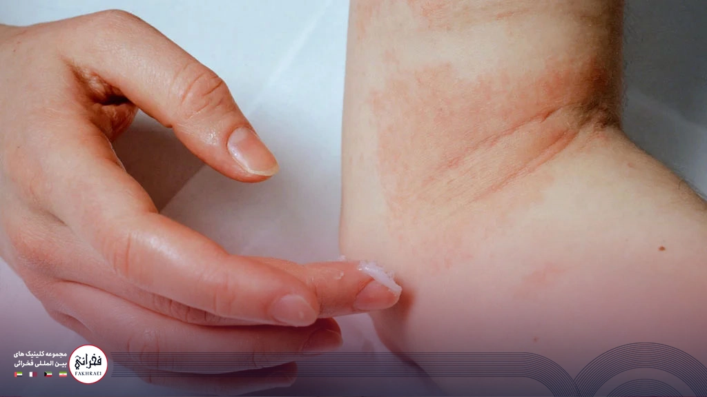 درمان اگزمای پوستی با روغن نارگیل