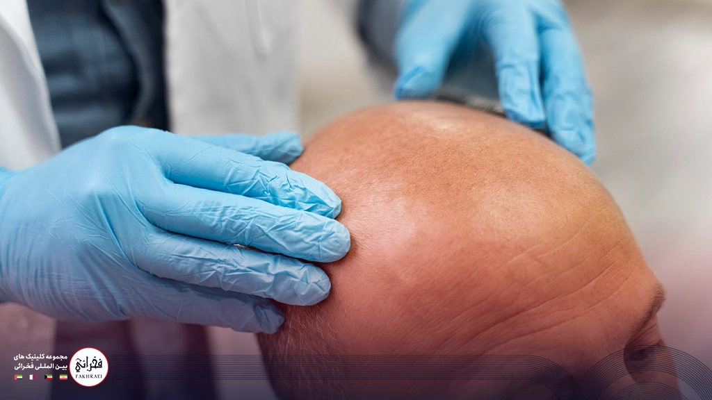 هزینه کاشت مو بر اساس تعداد تار مو