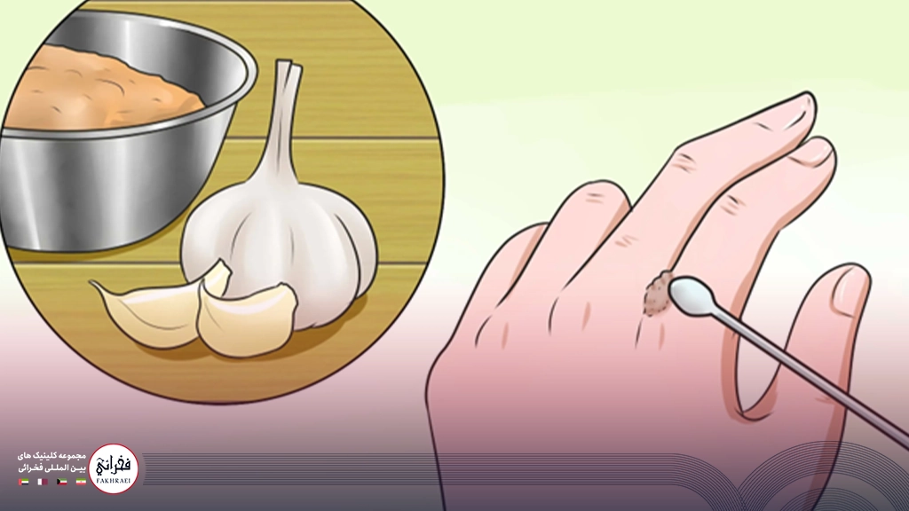 درمان خانگی زگیل تناسلی