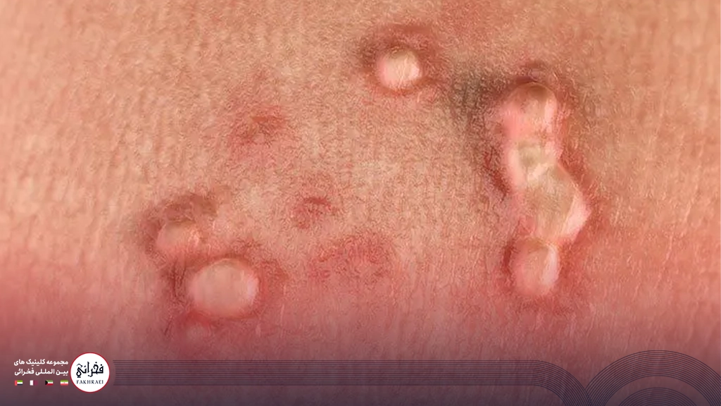 درمان زگیل تناسلی با لیزر