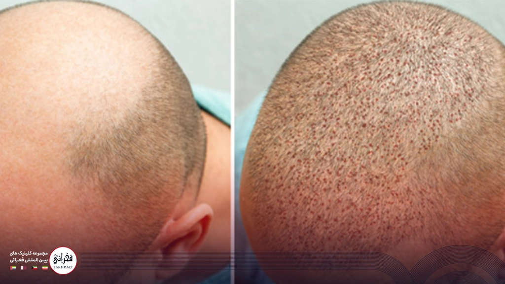 عکس یک هفته بعد از کاشت مو