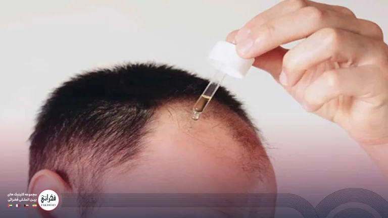 ماینوکسیدیل بعد از کاشت مو