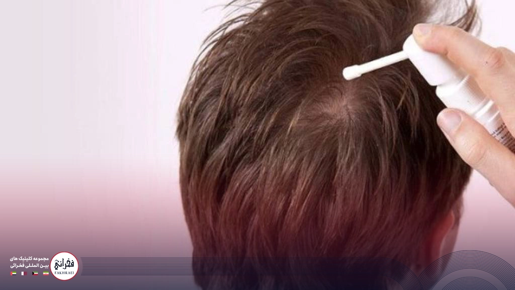 مزیت‌های ماینوکسیدیل بعد از کاشت مو نسبت به روش‌های دیگر