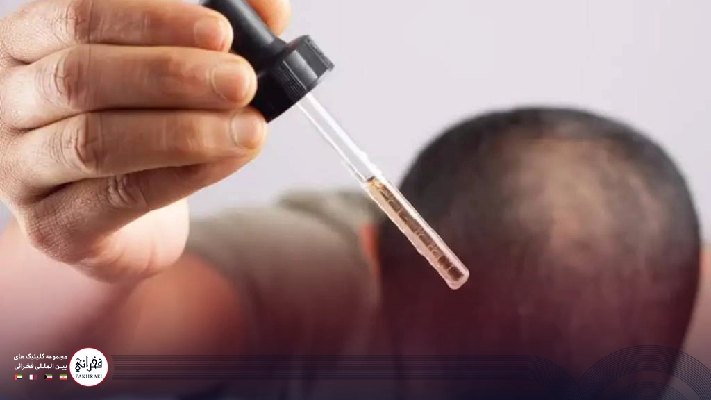 عملکرد ماینوکسیدیل بعد از کاشت مو