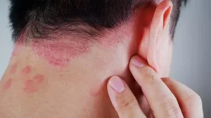 Psoriasis_article-768x432