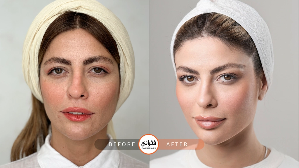 لیفت ابرو چیست؟