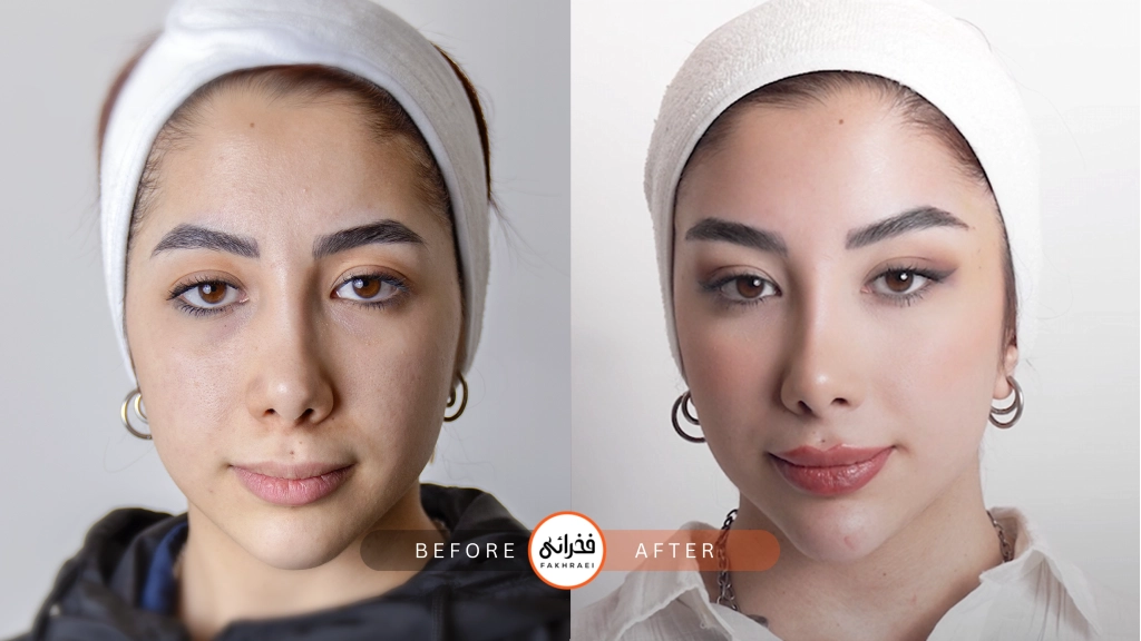 عکس قبل و بعد لیفت ابرو