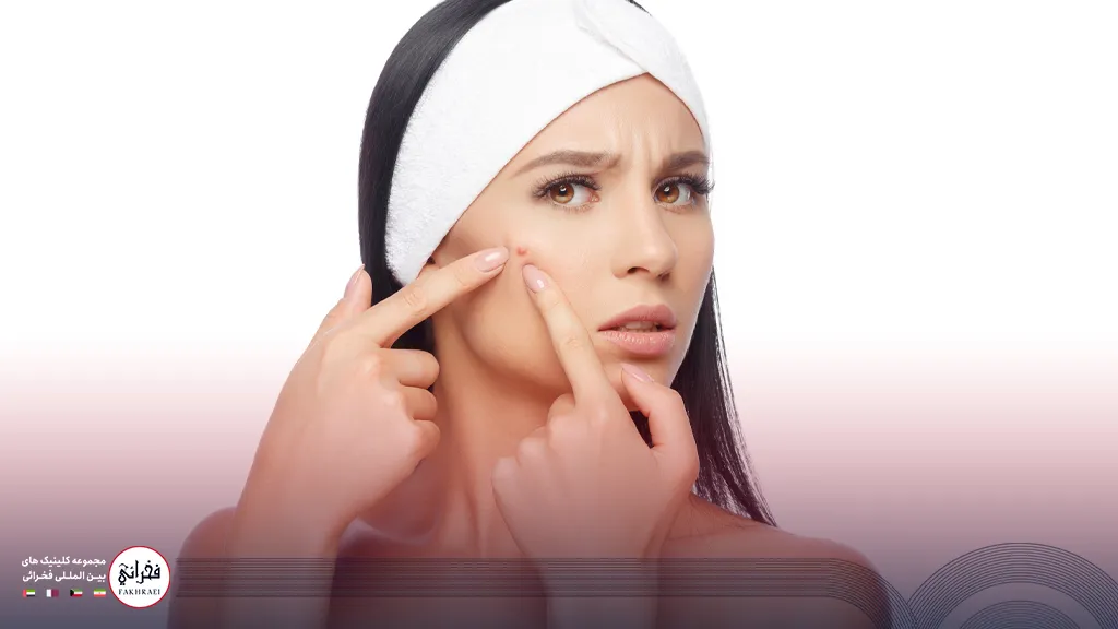 درمان جای جوش