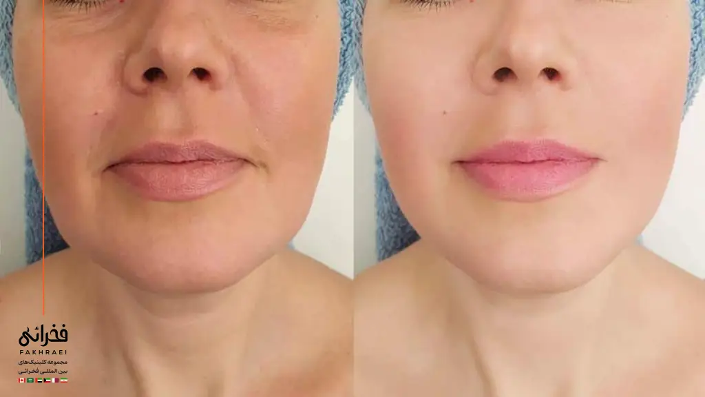 نتیجه تزریق مزوژل