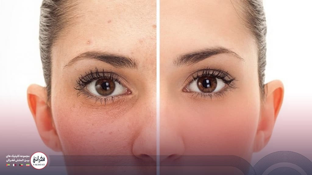 درمان جای جوش