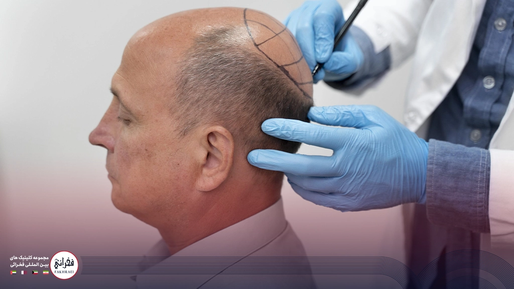 متخصص در حال بررسی سر مرد برای کاشت مو با با تراکم بالا