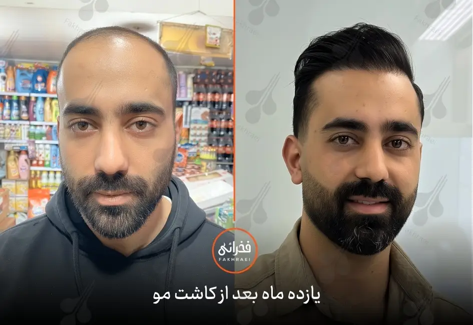 نتیجه کاشت مو بعد از 11 ماه