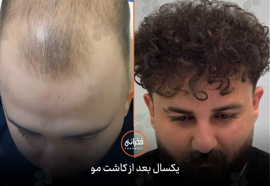 عکس کاشت مو بعد از یک سال