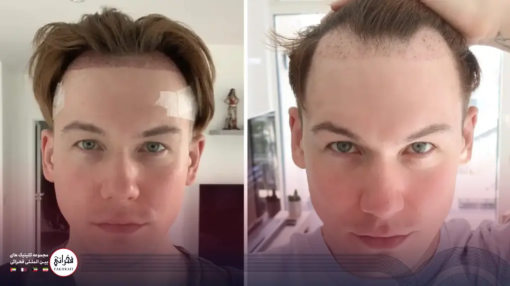 عکس کاشت مو بعد از یک ماه