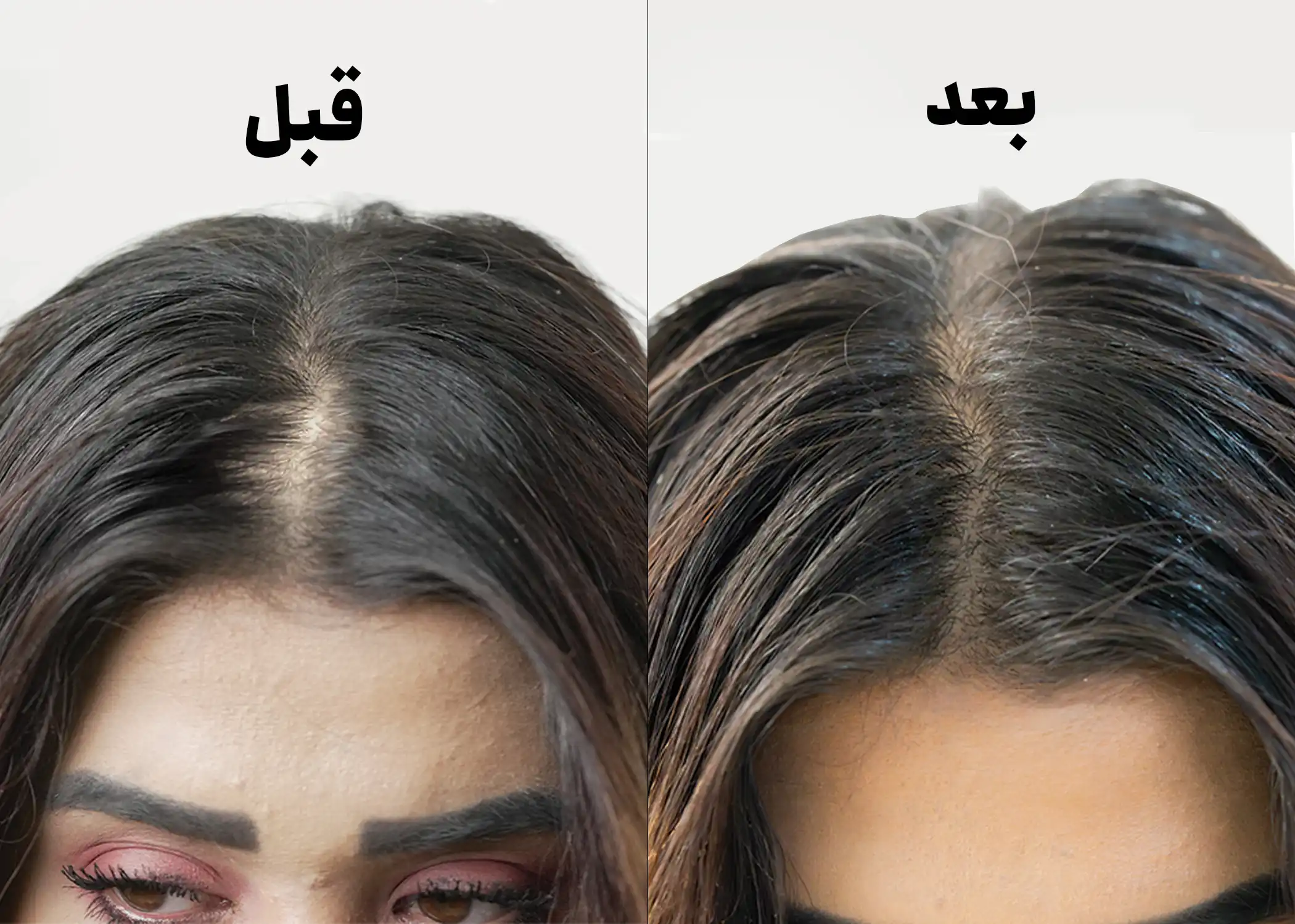 تصویر یک زن قبل و بعد از تزریق پی‌ آر پی