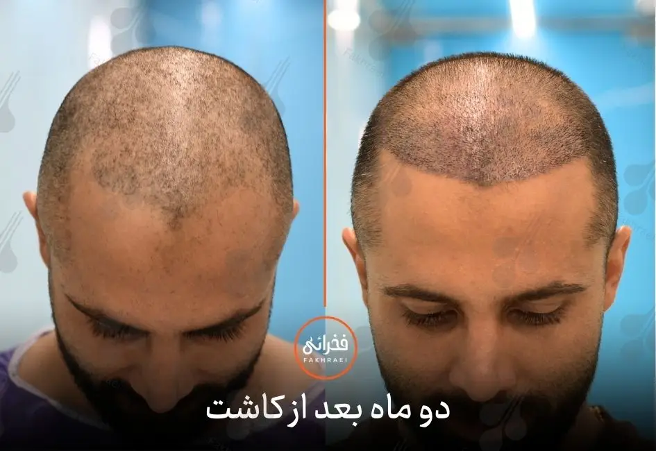 عکس کاشت مو بعد از دو ماه
