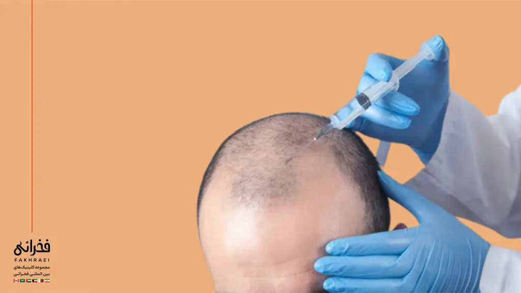 یک مرد در حال تزریق مزوتراپی بعد از کاشت مو