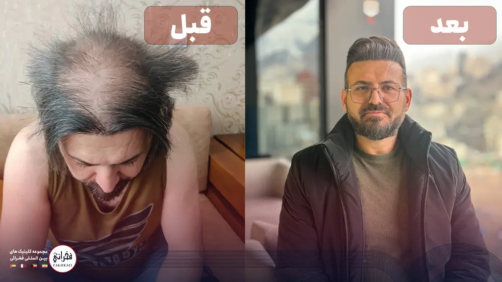 تصویر قبل و بعد از کاشت مو با تراکم بالا