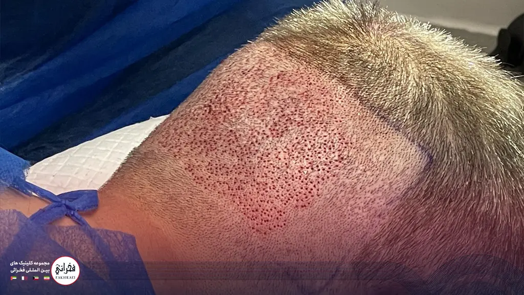 زخم کاشت مو در ناحیه بانک مو