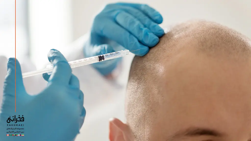 متخصص در حال تزریق مزوتراپی بعد از کاشت مو