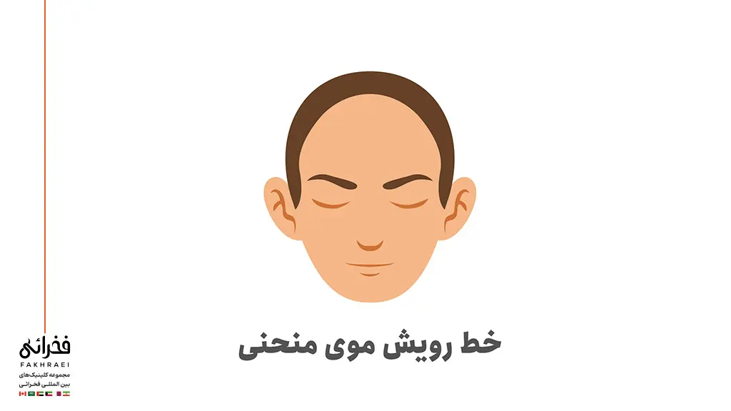 خط رویش موی گرد