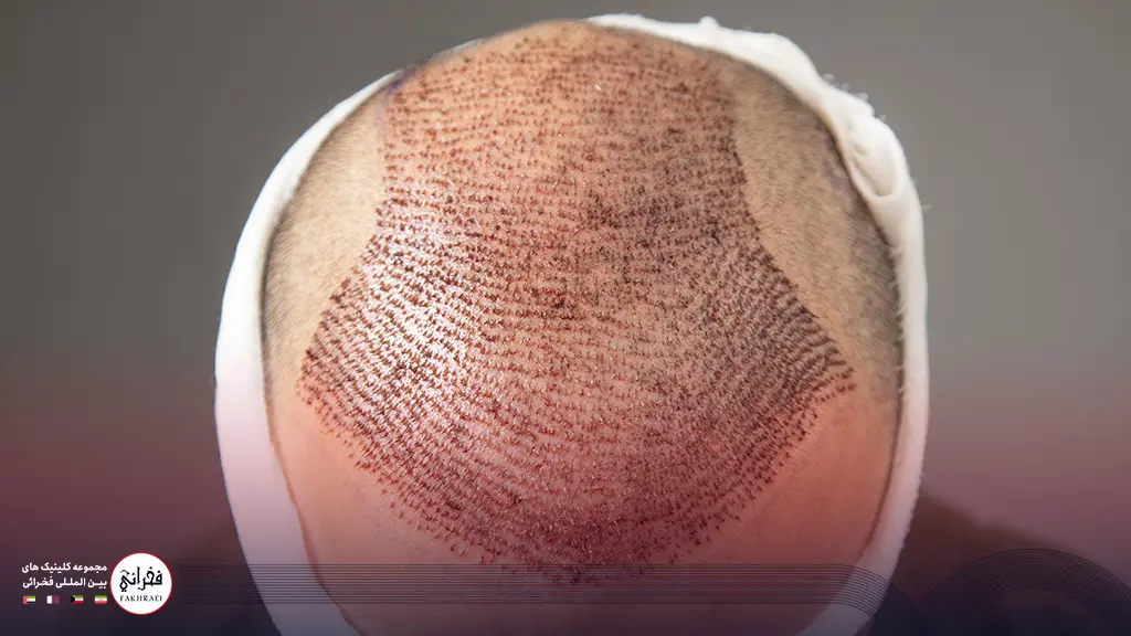 زخم در ناحیه کاشت مو