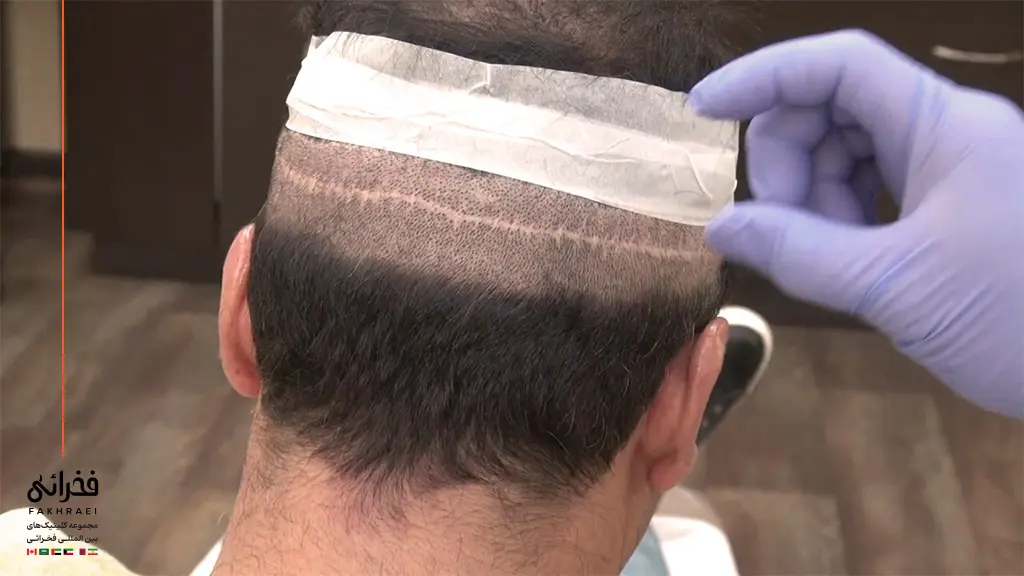 اسکار سر پس از کاشت FUT