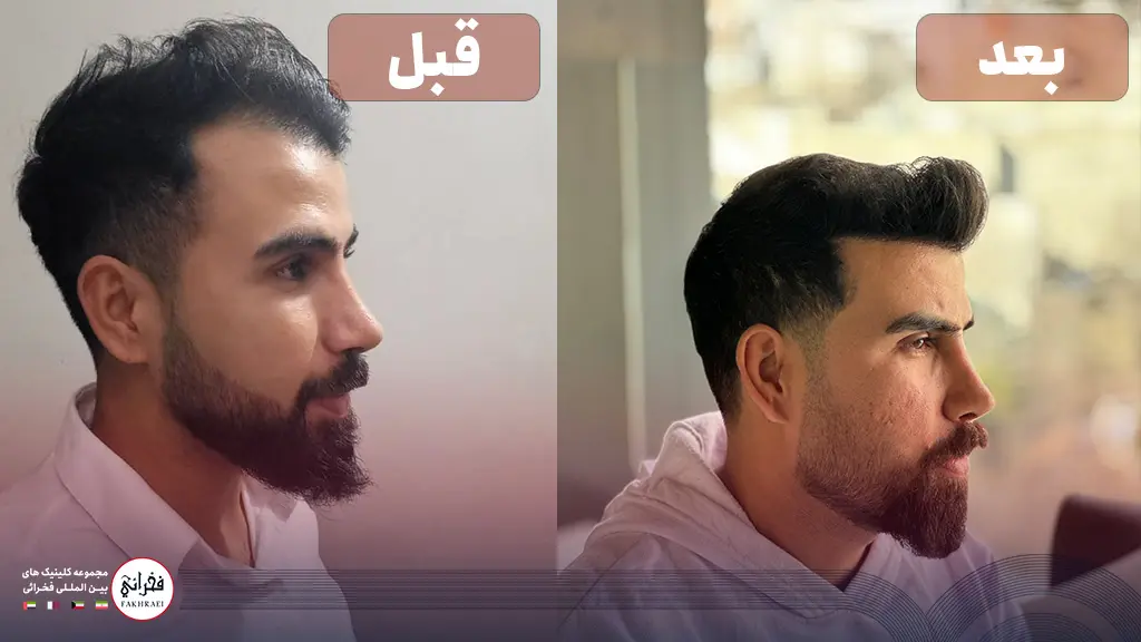 تصویر قبل و بعد از کاشت مو پرتراکم