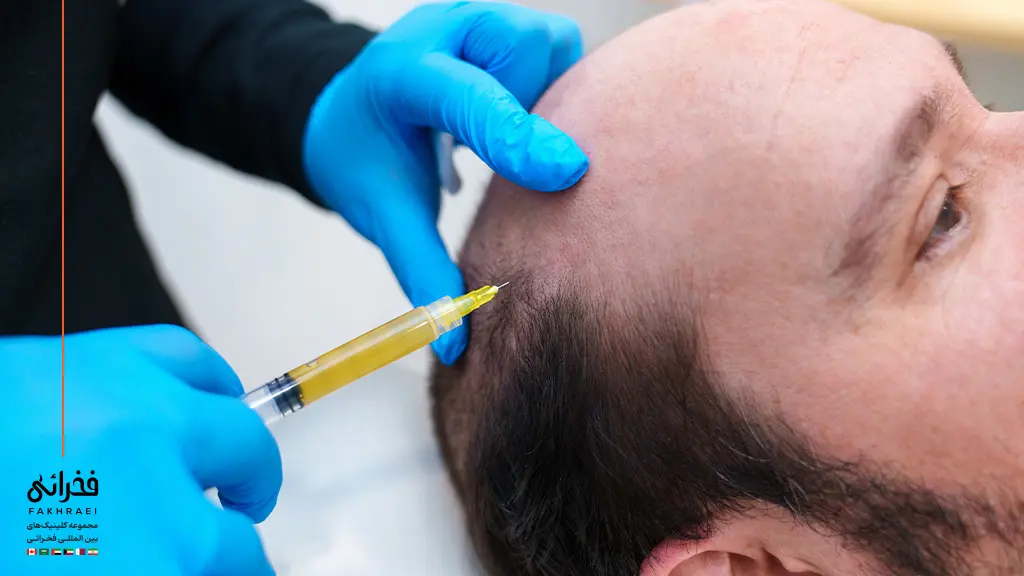 یک مرد در حال دریافت مزوتراپی پس از کاشت مو